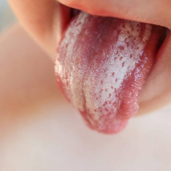 Nấm miệng ở trẻ em – Mách bạn cách nhận biết và xử trí