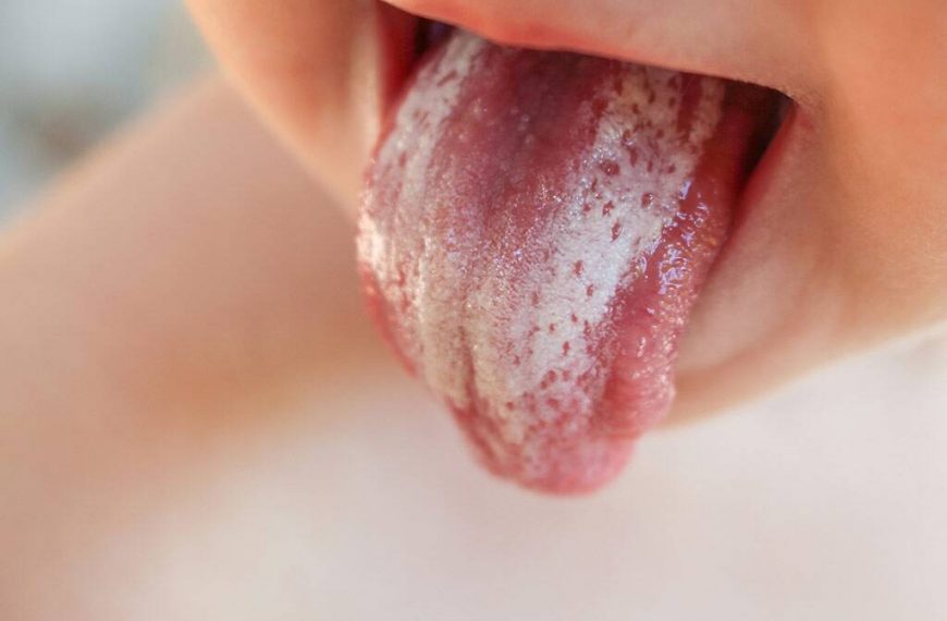 Nấm miệng ở trẻ em – Mách bạn cách nhận biết và xử trí